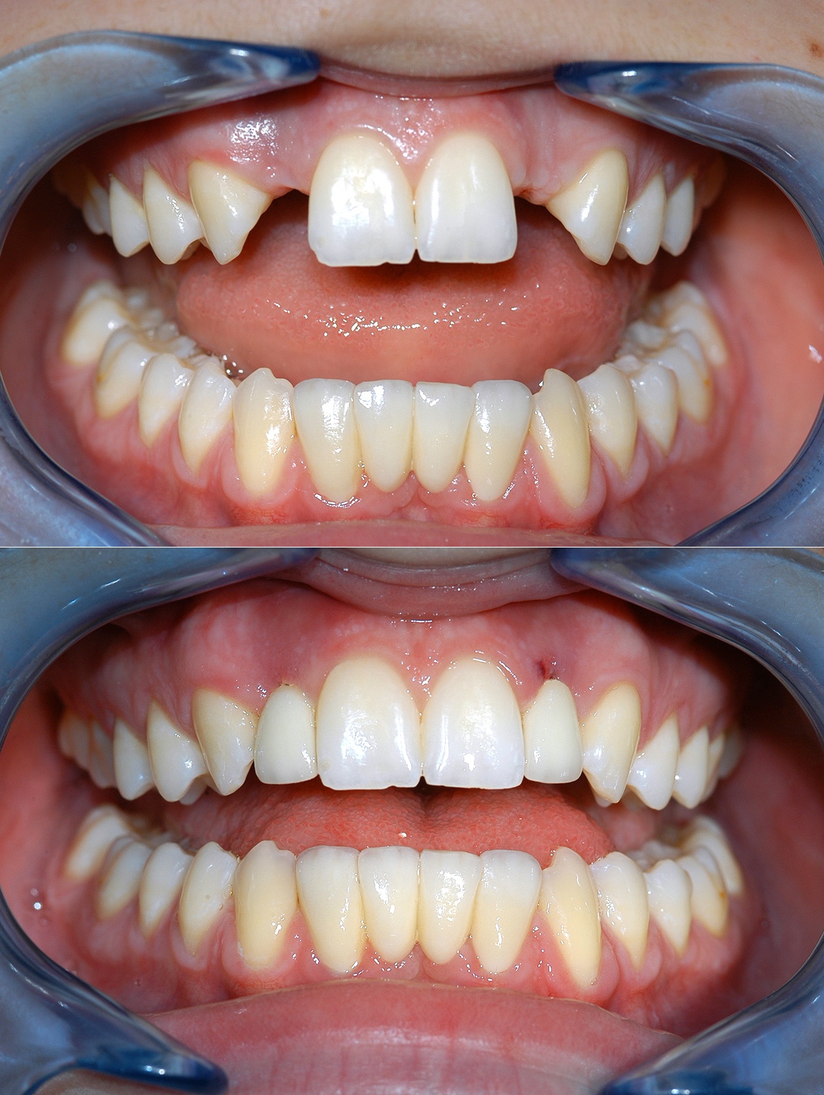 Cosmetic Veneers