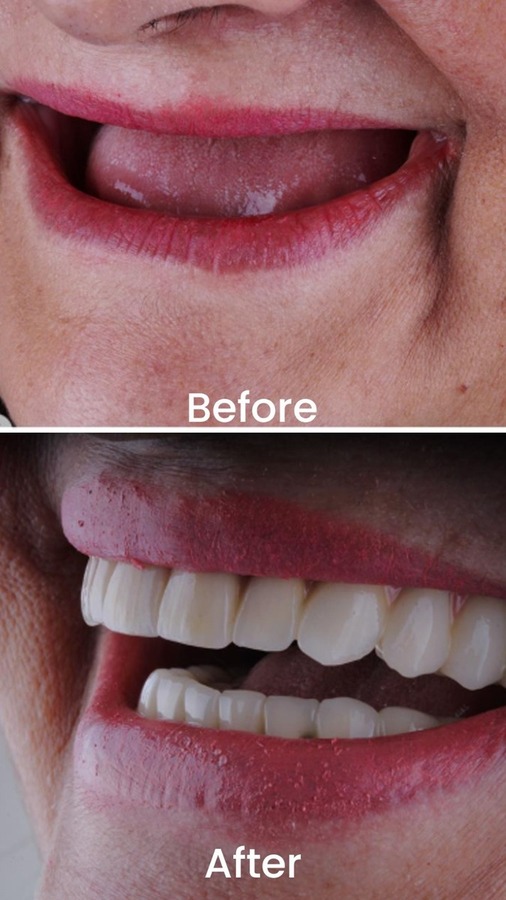 Implant Rehabilitation Case